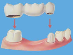 Root Canal In Upper East Side